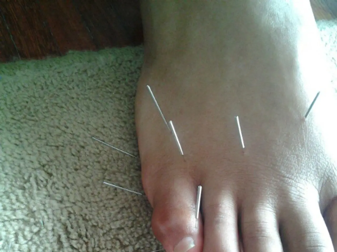 Differences Between Direct and Indirect Inguinal Hernias: Symptoms, Underlying Factors, and...